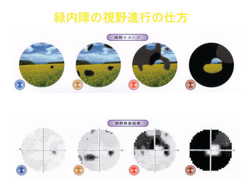 緑内障 ブログ